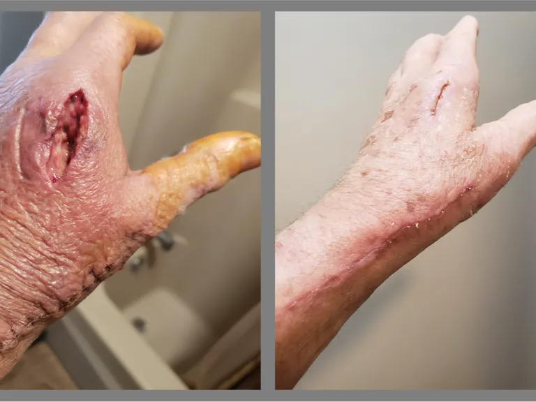 two pictures of hands demonstrating healing progress from the first to the second photo